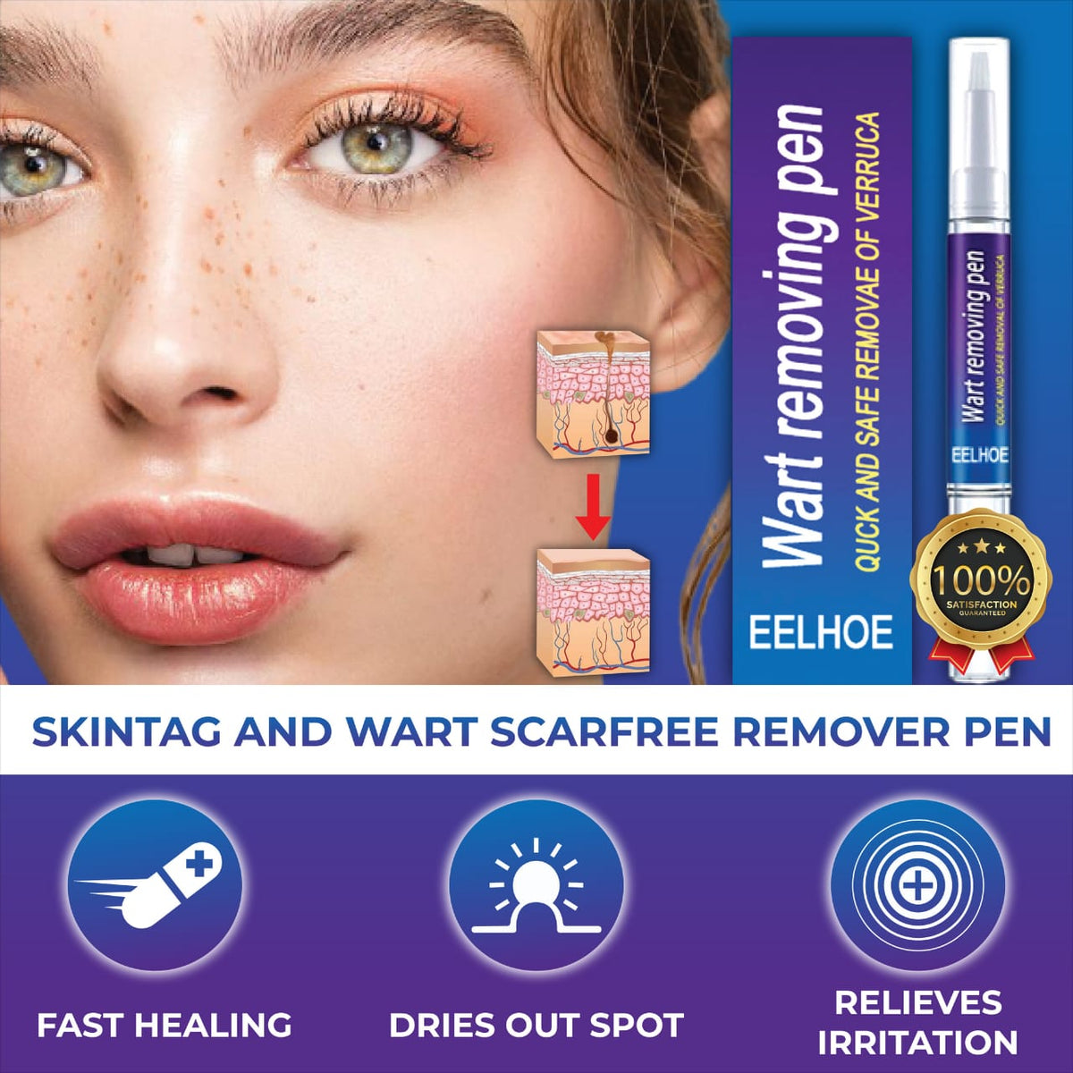 π©Ή Wart Remover Gel Pen β Complete Shopify Product Listing
